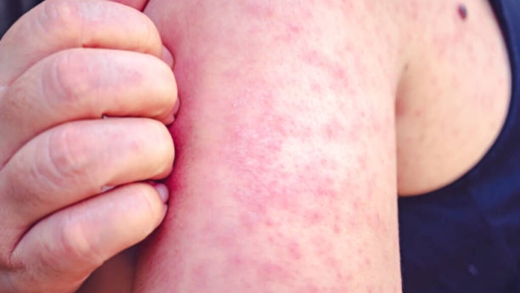 ALERTAN SOBRE SARAMPIÓN; EXHORTAN A VACUNARSE