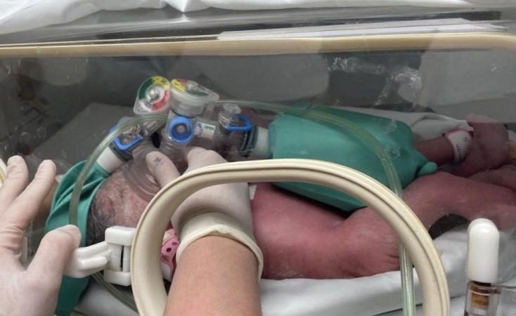 NACEN SIAMESAS UNIDAS POR EL ABDOMEN EN EL MATERNO INFANTIL